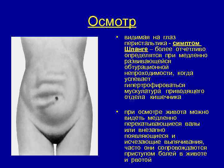 Осмотр • видимая на глаз перистальтика - симптом Шланге – более отчетливо определятся при