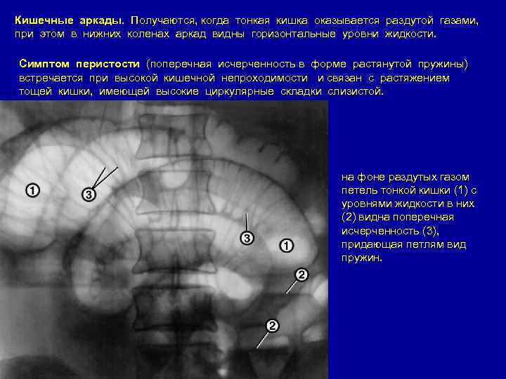 Кишечные аркады. Получаются, когда тонкая кишка оказывается раздутой газами, при этом в нижних коленах