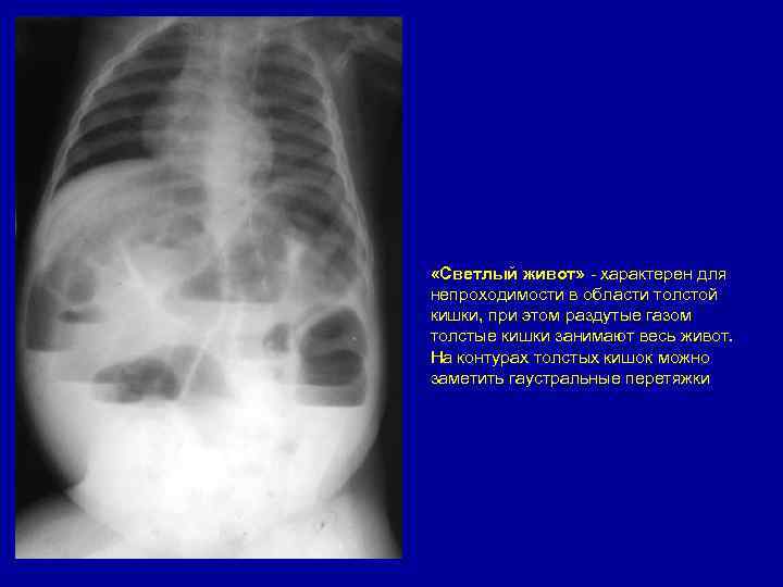  «Светлый живот» - характерен для непроходимости в области толстой кишки, при этом раздутые