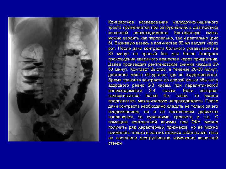 Контрастное исследование желудочно-кишечного тракта применяется при затруднениях в диагностике кишечной непроходимости. Контрастную смесь можно