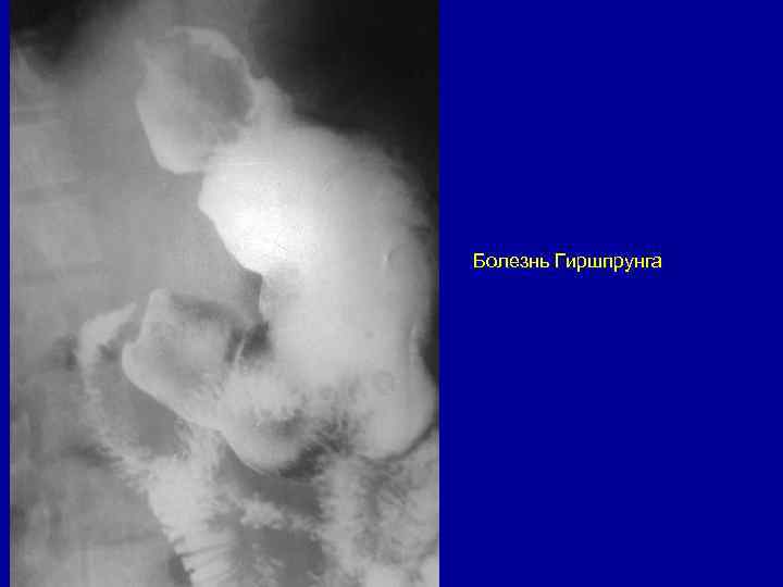 Болезнь Гиршпрунга 