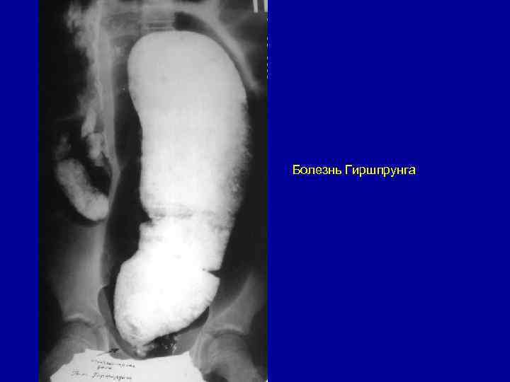 Болезнь Гиршпрунга 