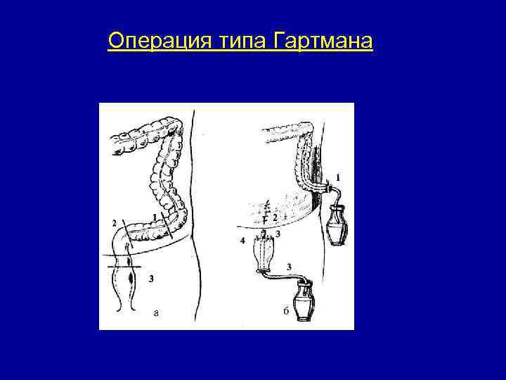 Операция типа Гартмана 