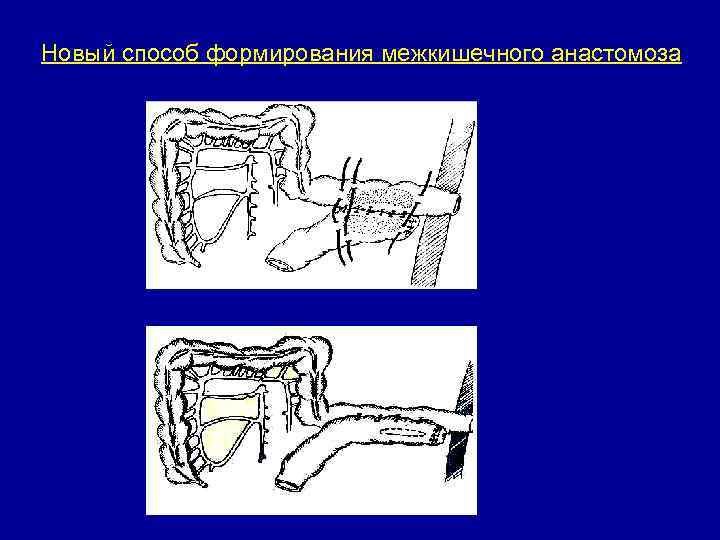 Новый способ формирования межкишечного анастомоза 