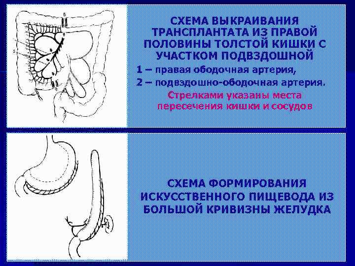 СХЕМА ВЫКРАИВАНИЯ ТРАНСПЛАНТАТА ИЗ ПРАВОЙ ПОЛОВИНЫ ТОЛСТОЙ КИШКИ С УЧАСТКОМ ПОДВЗДОШНОЙ 1 – правая