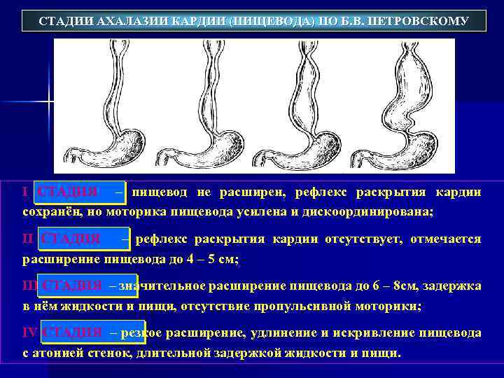 Расширение пищевода