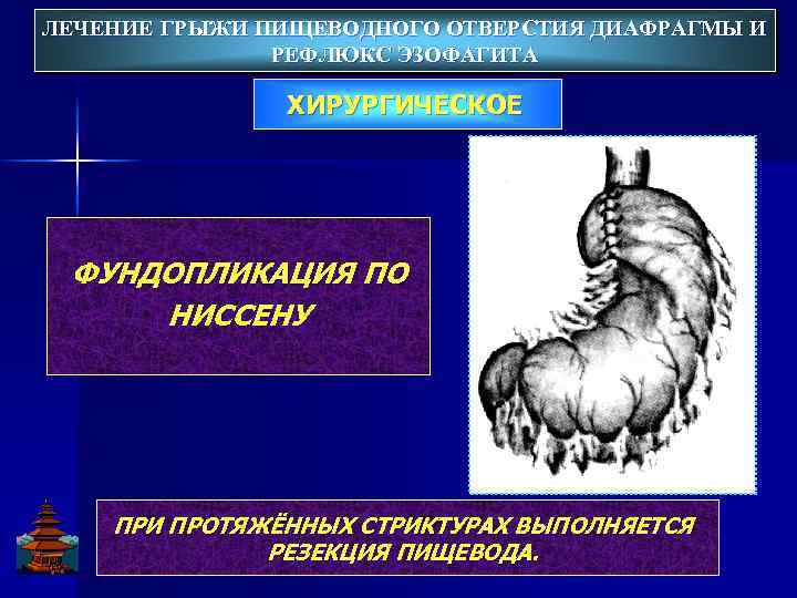 ЛЕЧЕНИЕ ГРЫЖИ ПИЩЕВОДНОГО ОТВЕРСТИЯ ДИАФРАГМЫ И ЛЕЧЕНИЕ ГРЫЖИ ПИЩЕВОДНОГО ОТВЕРСТИЯ ДИАФРАГМЫ РЕФЛЮКС ЭЗОФАГИТА ХИРУРГИЧЕСКОЕ