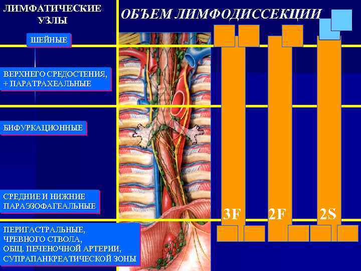 ЛИМФАТИЧЕСКИЕ УЗЛЫ ОБЪЕМ ЛИМФОДИССЕКЦИИ ШЕЙНЫЕ ВЕРХНЕГО СРЕДОСТЕНИЯ, + ПАРАТРАХЕАЛЬНЫЕ БИФУРКАЦИОННЫЕ СРЕДНИЕ И НИЖНИЕ ПАРАЭЗОФАГЕАЛЬНЫЕ
