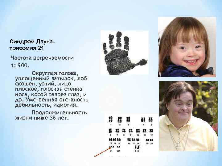 Синдром Даунатрисомия 21 Частота встречаемости 1: 900. Округлая голова, уплощенный затылок, лоб скошен, узкий,