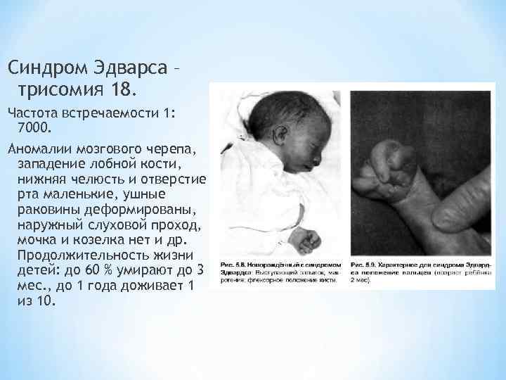 Синдром Эдварса – трисомия 18. Частота встречаемости 1: 7000. Аномалии мозгового черепа, западение лобной