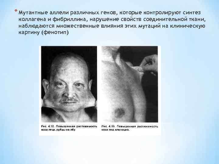 * Мутантные аллели различных генов, которые контролируют синтез коллагена и фибриллина, нарушение свойств соединительной