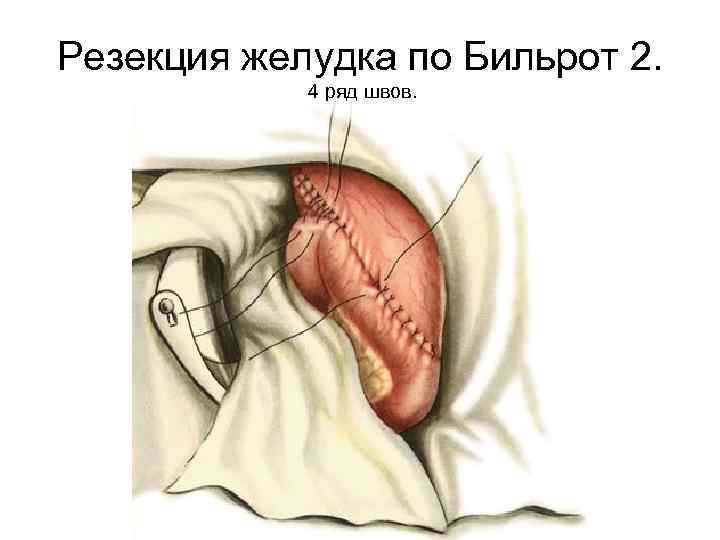 Резекция желудка по Бильрот 2. 4 ряд швов. 