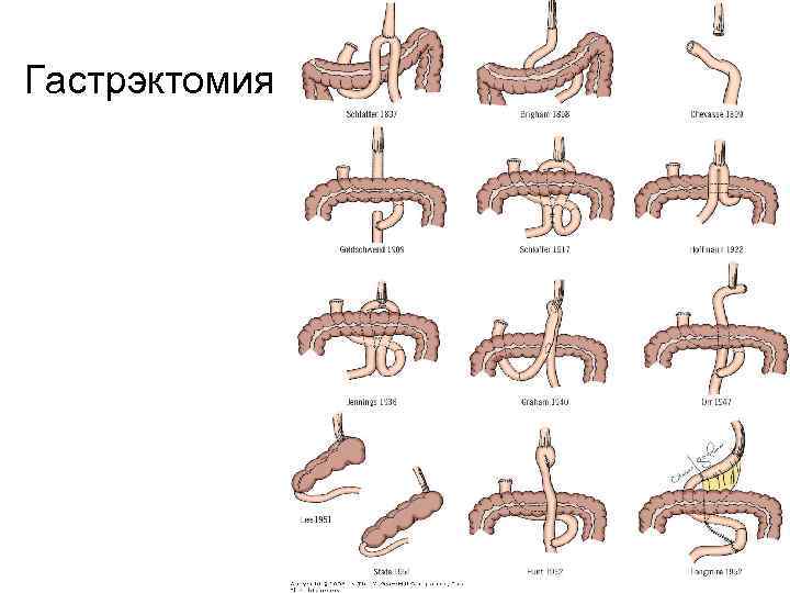 Гастрэктомия 