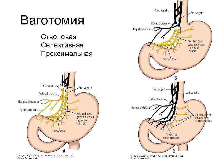Ваготомия Стволовая Селективная Проксимальная 