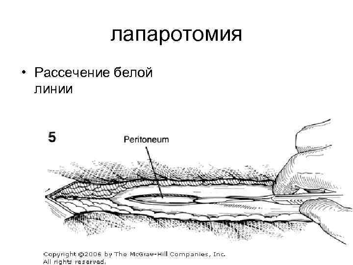 лапаротомия • Рассечение белой линии 