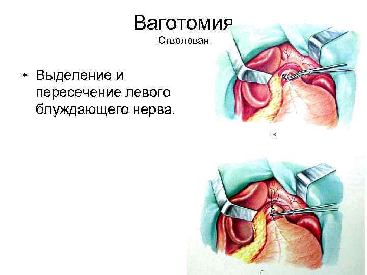Ваготомия Стволовая • Выделение и пересечение левого блуждающего нерва. 