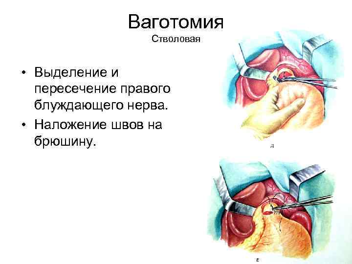 Ваготомия Стволовая • Выделение и пересечение правого блуждающего нерва. • Наложение швов на брюшину.