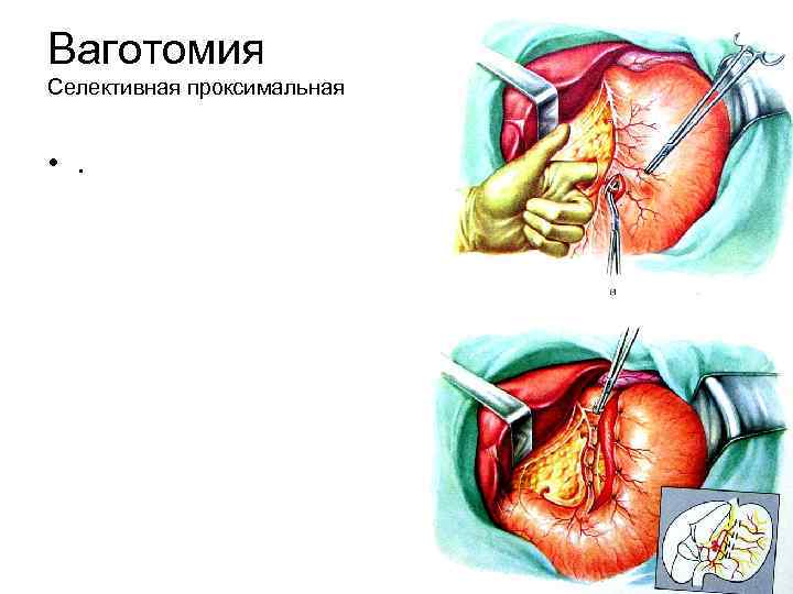 Ваготомия Селективная проксимальная • . 