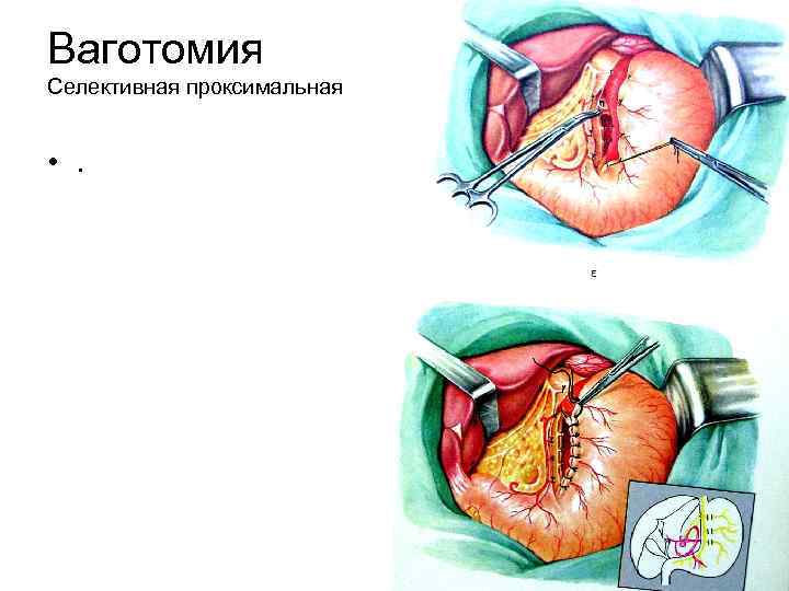 Ваготомия Селективная проксимальная • . 