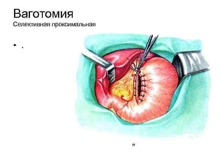 Ваготомия Селективная проксимальная • . 