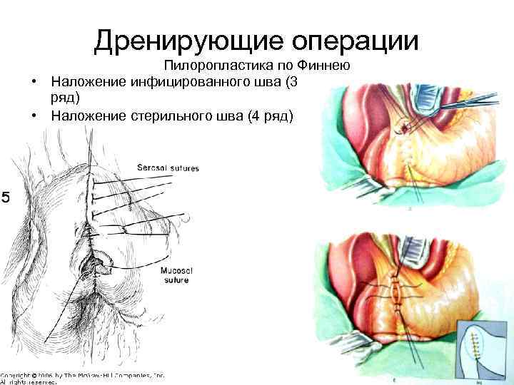 Дренирующие операции Пилоропластика по Финнею • Наложение инфицированного шва (3 ряд) • Наложение стерильного