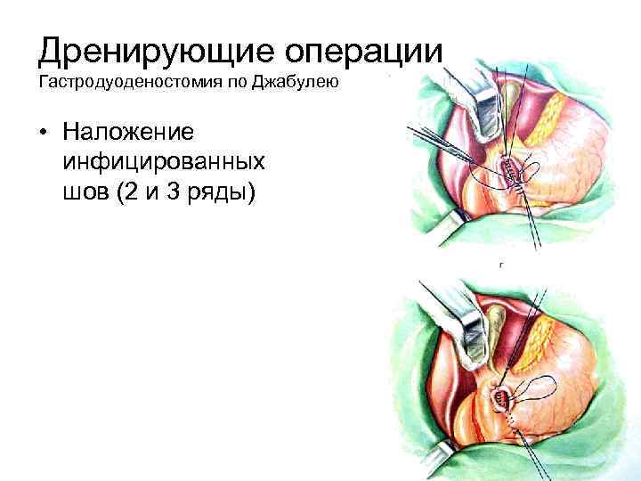 Дренирующие операции Гастродуоденостомия по Джабулею • Наложение инфицированных шов (2 и 3 ряды) 
