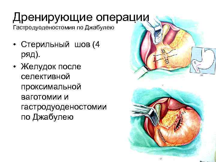 Дренирующие операции Гастродуоденостомия по Джабулею • Стерильный шов (4 ряд). • Желудок после селективной