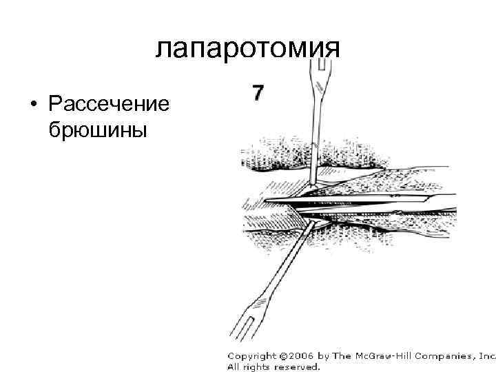лапаротомия • Рассечение брюшины 