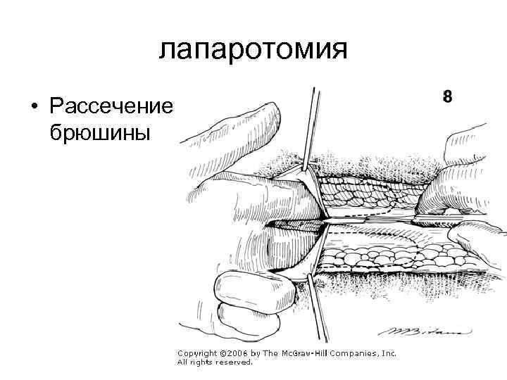 лапаротомия • Рассечение брюшины 