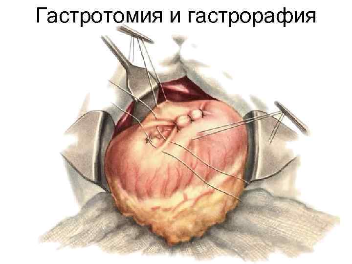 Гастротомия и гастрорафия 