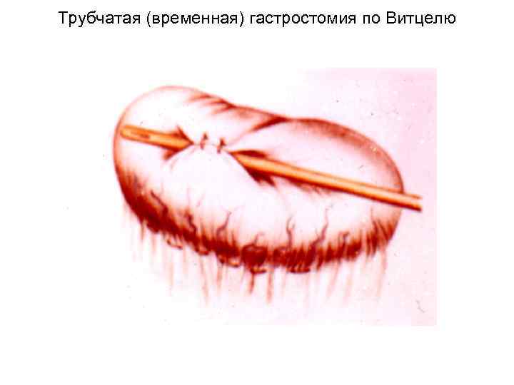 Трубчатая (временная) гастростомия по Витцелю 