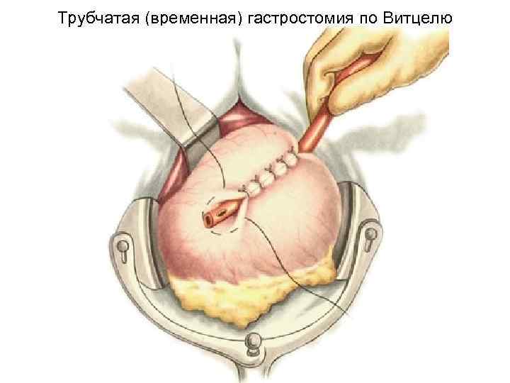 Трубчатая (временная) гастростомия по Витцелю 