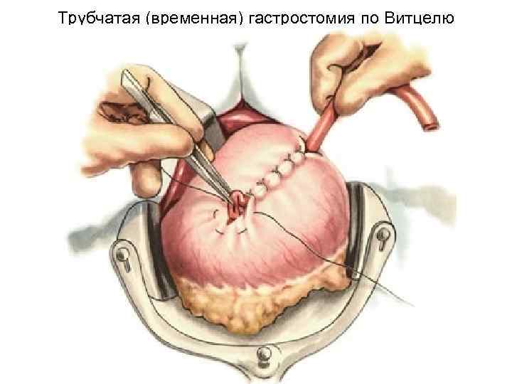 Трубчатая (временная) гастростомия по Витцелю 
