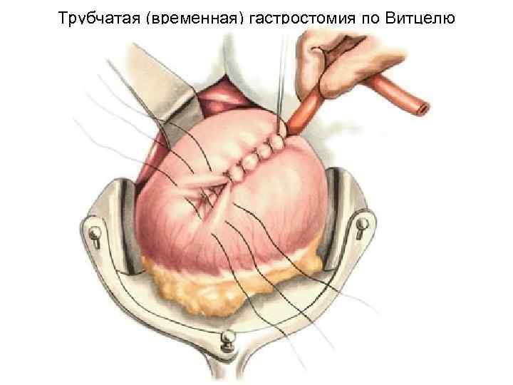 Трубчатая (временная) гастростомия по Витцелю 