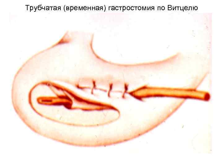 Трубчатая (временная) гастростомия по Витцелю 