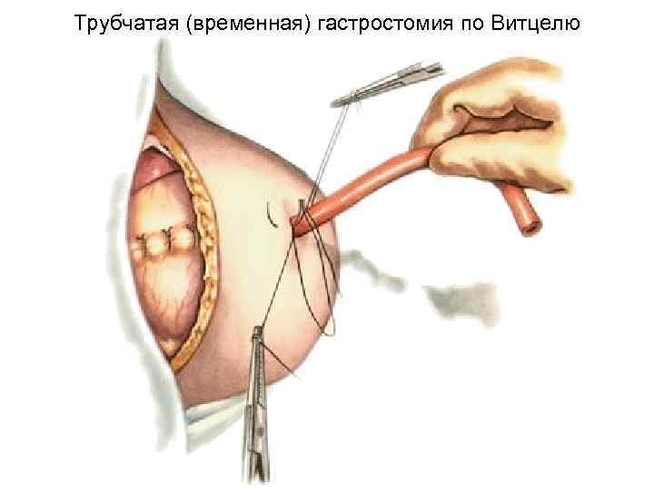 Трубчатая (временная) гастростомия по Витцелю 