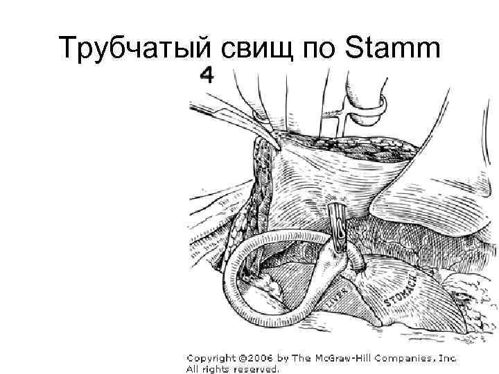 Трубчатый свищ по Stamm 