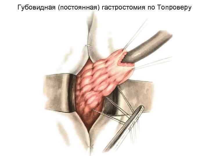 Губовидная (постоянная) гастростомия по Топроверу 