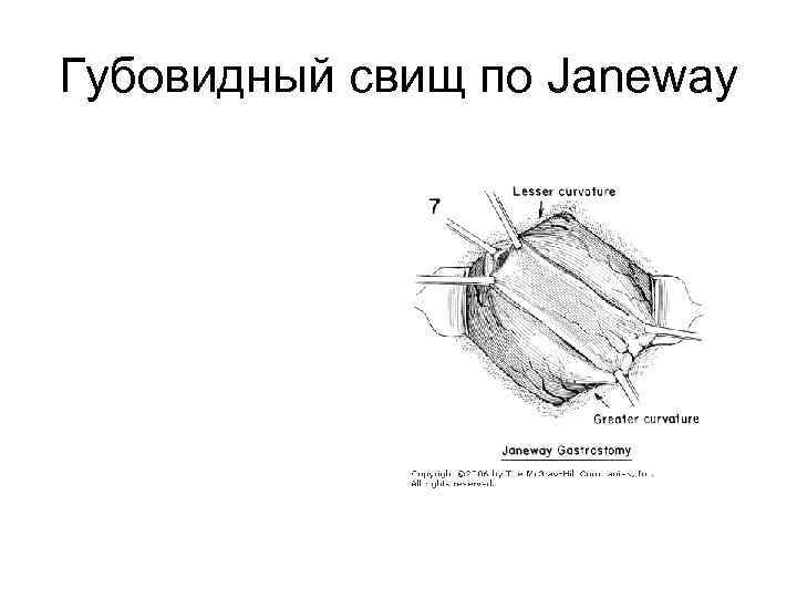 Губовидный свищ по Janeway 