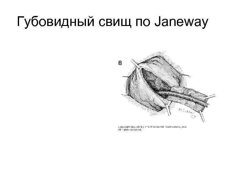 Губовидный свищ по Janeway 