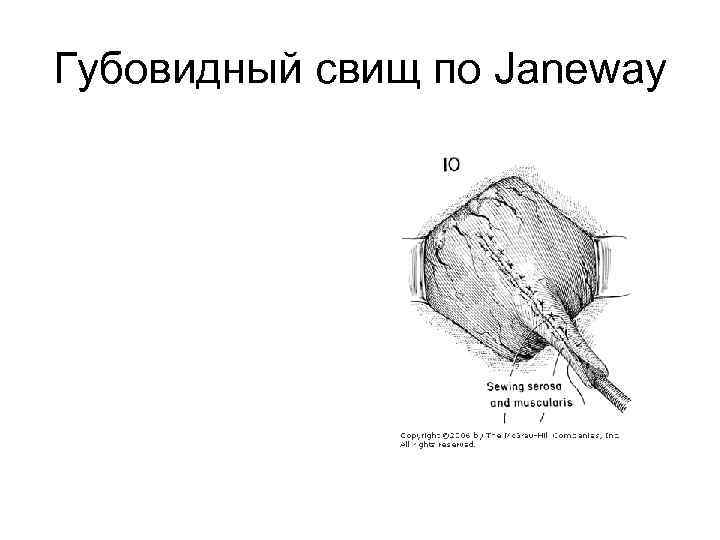 Губовидный свищ по Janeway 