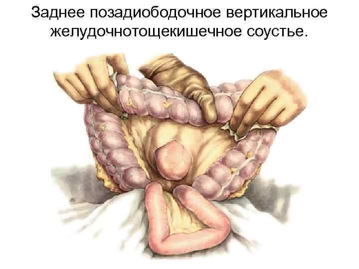 Заднее позадиободочное вертикальное желудочнотощекишечное соустье. 