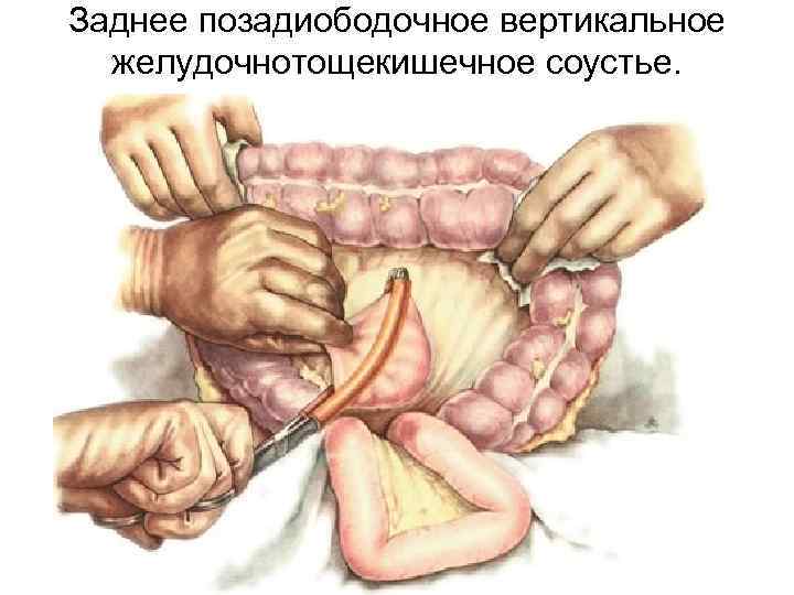 Заднее позадиободочное вертикальное желудочнотощекишечное соустье. 