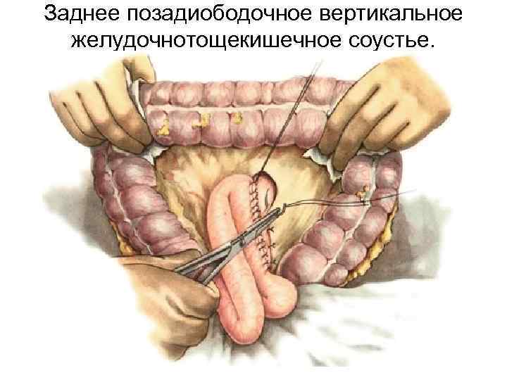 Заднее позадиободочное вертикальное желудочнотощекишечное соустье. 