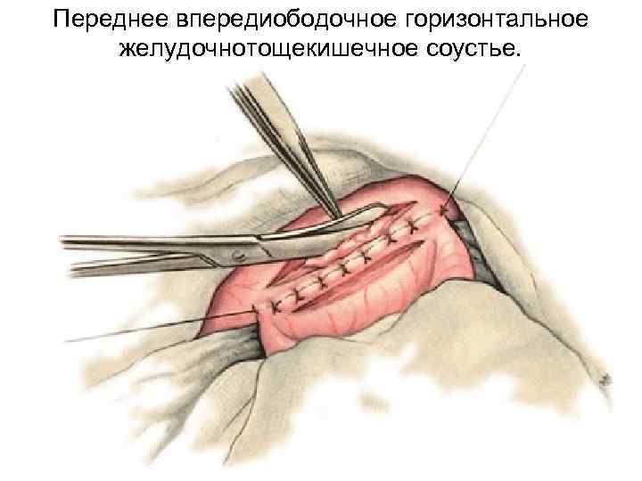 Переднее впередиободочное горизонтальное желудочнотощекишечное соустье. 