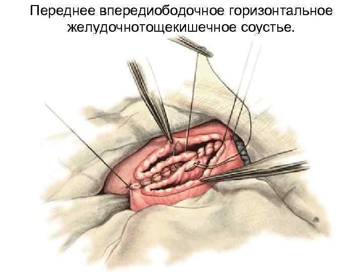 Переднее впередиободочное горизонтальное желудочнотощекишечное соустье. 