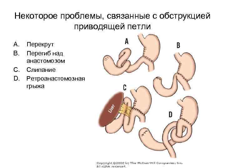 Некоторое проблемы, связанные с обструкцией приводящей петли A. B. C. D. Перекрут Перегиб над