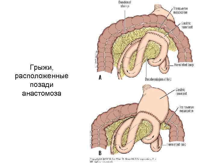 Грыжи, расположенные позади анастомоза 