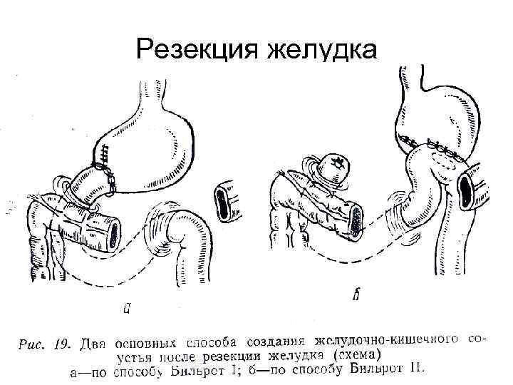 Резекция желудка 