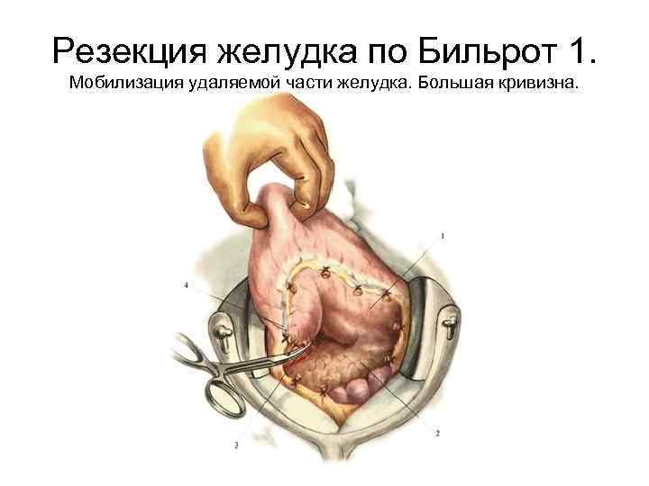 Резекция желудка по Бильрот 1. Мобилизация удаляемой части желудка. Большая кривизна. 